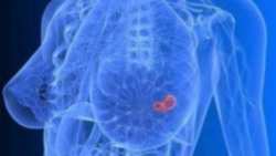 &Epsilon;&nu;&eta;&mu;&epsilon;&rho;&omega;&tau;&iota;&kappa;ή &epsilon;&kappa;&delta;ή&lambda;&omega;&sigma;&eta; &gamma;&iota;&alpha; &tau;&eta;&nu; &pi;&rho;ό&lambda;&eta;&psi;&eta; &tau;&omicron;&upsilon; &kappa;&alpha;&rho;&kappa;ί&nu;&omicron;&upsilon; &tau;&omicron;&upsilon; &mu;&alpha;&sigma;&tau;&omicron;ύ